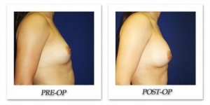 phoca_thumb_l_cohen-breast-augmentation-031