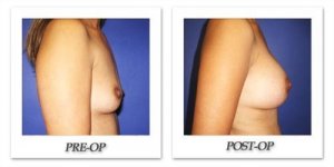 phoca_thumb_l_cohen-breast-augmentation-033