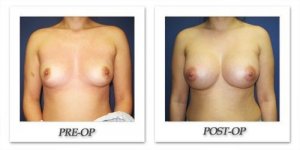 phoca_thumb_l_cohen-breast-augmentation-037