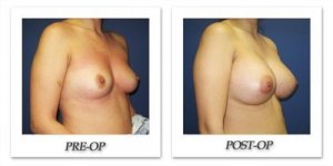 phoca_thumb_l_cohen-breast-augmentation-039