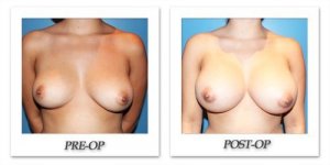 phoca_thumb_l_cohen-breastaugmentation-front