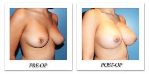 phoca_thumb_l_cohen-breastaugmentation-oblique