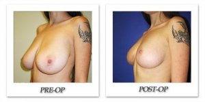 phoca_thumb_l_cohen-breast-reduction-009