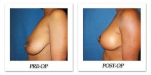 phoca_thumb_l_cohen-breast-reduction-019