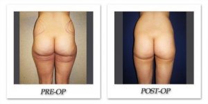 phoca_thumb_l_cohen-liposuction-007