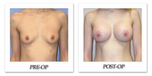 Breast Augmentation