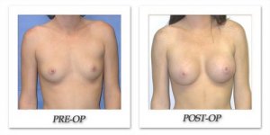 Breast Augmentation