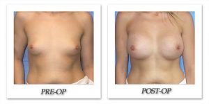 Breast Augmentation