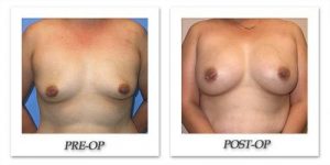 Breast Augmentation