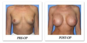 Breast Augmentation