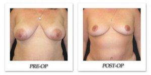 phoca_thumb_l_mandris-breast-reduction-001