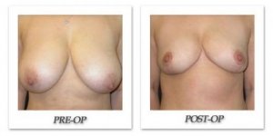 phoca_thumb_l_mandris-breast-reduction-006