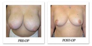 phoca_thumb_l_mandris-breast-reduction-007