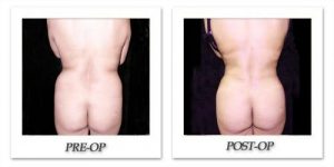 Buttock Enhancements