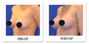 breast-augmentation-1