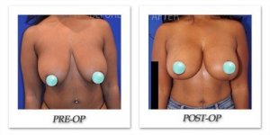 phoca_thumb_l_breast-lift-1