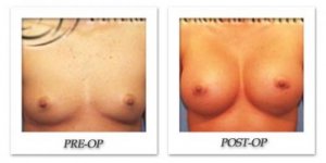 phoca_thumb_l_hodnett-breast-augmentation-002