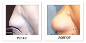 phoca_thumb_l_hodnett-breast-augmentation-005
