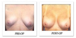 phoca_thumb_l_hodnett-breast-augmentation-006