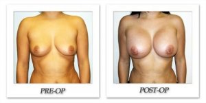 phoca_thumb_l_hodnett-breast-augmentation-009