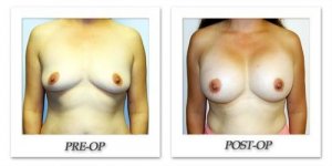 phoca_thumb_l_hodnett-breast-augmentation-010