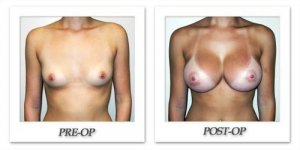 phoca_thumb_l_hodnett-breast-augmentation-013