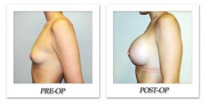 phoca_thumb_l_hodnett-breast-augmentation-017