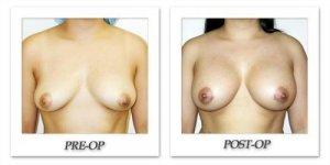 phoca_thumb_l_hodnett-breast-augmentation-020