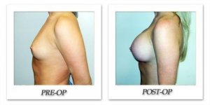 phoca_thumb_l_hodnett-breast-augmentation-031
