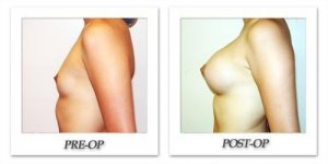 phoca_thumb_l_hodnett-breast-augmentation-033