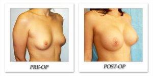 phoca_thumb_l_hodnett-breast-augmentation-036