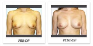 phoca_thumb_l_hodnett-breast-augmentation-040