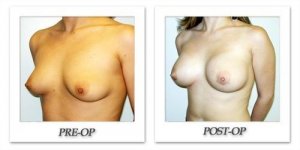 phoca_thumb_l_hodnett-breast-augmentation-041