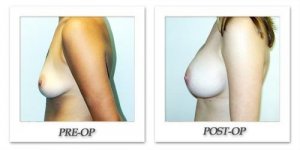 phoca_thumb_l_hodnett-breast-augmentation-043