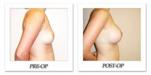 phoca_thumb_l_hodnett-breast-augmentation-049