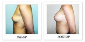 phoca_thumb_l_hodnett-breast-augmentation-054