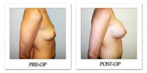 phoca_thumb_l_hodnett-breast-augmentation-055