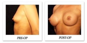 phoca_thumb_l_hodnett-breast-augmentation-patient10-oblique