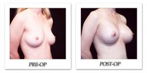phoca_thumb_l_hodnett-breast-augmentation-patient11-oblique