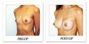 phoca_thumb_l_hodnett-breast-augmentation-patient3-oblique