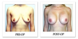 phoca_thumb_l_hodnett-breast-augmentation-patient9-front