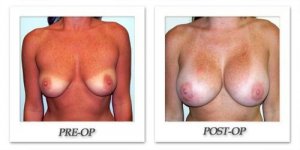 phoca_thumb_l_patient12-hodnett-breast-augmentation-front