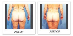 phoca_thumb_l_hodnett-liposuction-009