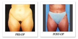 phoca_thumb_l_hodnett-liposuction-012