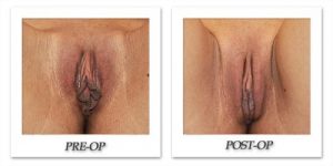 Female Corrective & Vaginal Rejuvenation by Dr. Begovic