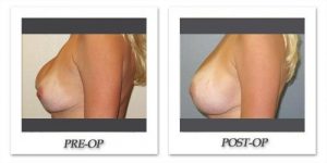 Breast Augmentation Revision by Dr. Kincaid