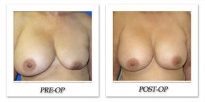 Breast Augmentation Revision by Dr. Kincaid