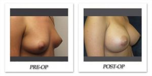 Breast Augmentation by Dr. Kincaid