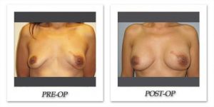 Breast Reconstruction by Dr. Kincaid