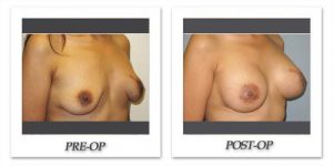 Breast Reconstruction by Dr. Kincaid